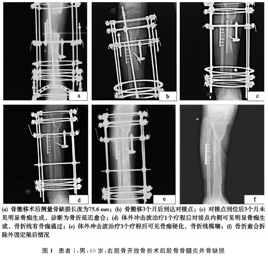 骨搬移术后对接端不愈合的治疗新手段