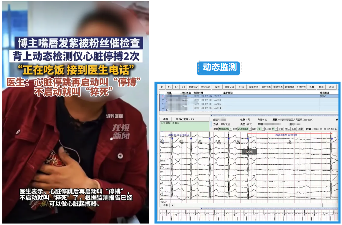 动态心电监测 动态心电监测